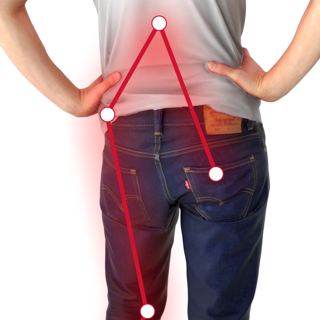 Sciatica diagram