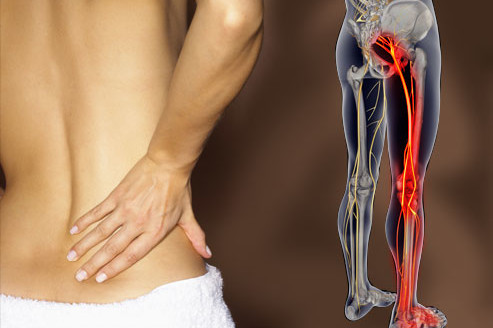 Picture Showing Sciatica Pain And The Sciatic Nerve