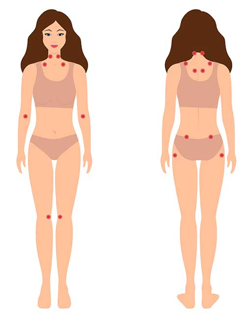 Diagram showing fibromyalgia pain points